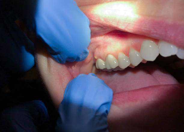 Best Dentist for Tooth Abscess  in West Hurley, NY